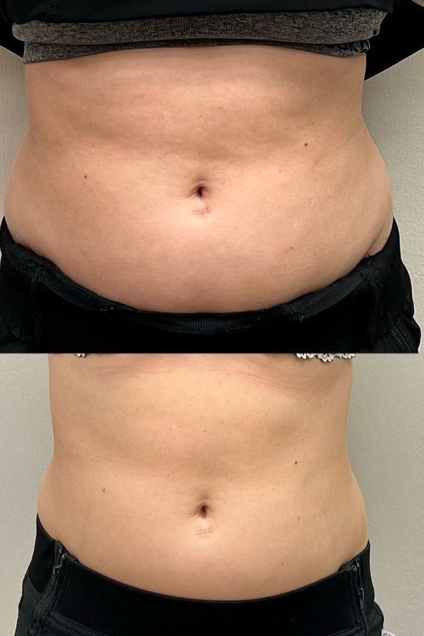 Antes y después paciente 1