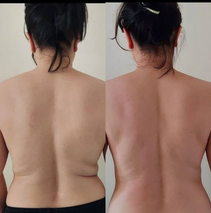 Antes y después paciente 3